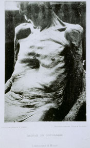 Photograph of a patient from Nouvelle Iconographie de la Salpetriere (UCL Institute of Neurology)